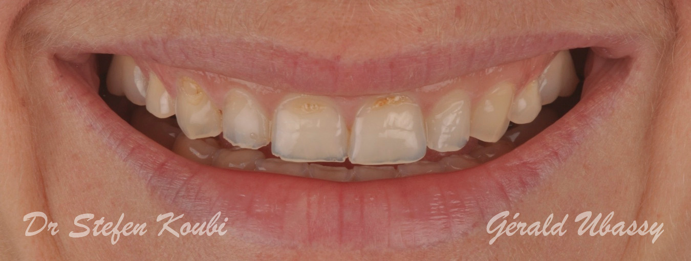 Veneers Dr Koubi/Ubassy